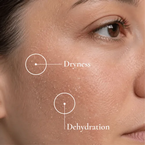 Dryness concern