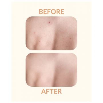 Priveda: Spot clearing Patch, Hydrocolloid Large Acne Pimple Patch Spot Treatment - 10 Patches