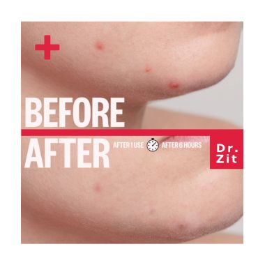 Spot Patch: Dr Zit 42 Acne Pimple Patches - 42 Pcs