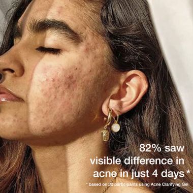 SKOG: Acne Clarifying Gel - 30ml