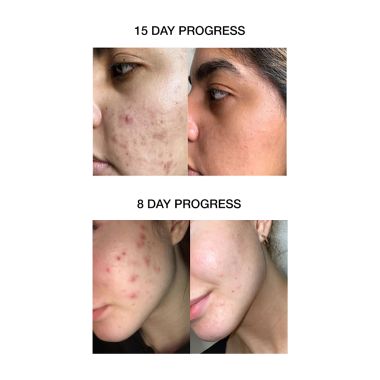 SKOG: Acne Clarifying Gel - 30ml