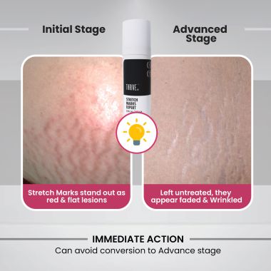 Thriveco: Stretch Mark Expert Serum Cream - 30ml