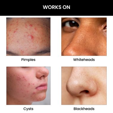 Thriveco: Goodbye Acne Serum, 30 ml