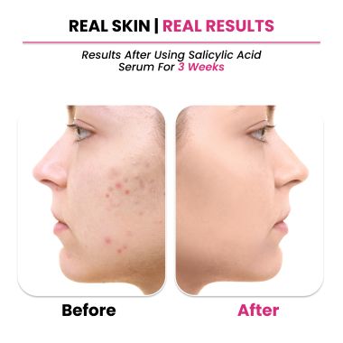 Thriveco: 2% Salicylic acid Serum, 30ml