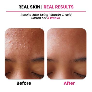 Thriveco: 10% Vitamin C+ Hyaluronic Acid Serum, 30ml