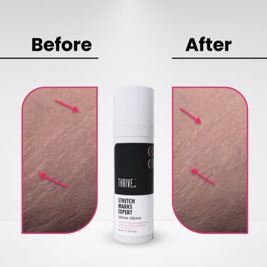 Thriveco: Stretch Mark Expert Serum Cream - 30ml