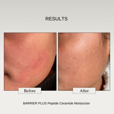 The FormulaRX: Peptide Ceramide Moisturizer - Barrier Plus - Nourishing Barrier Repair Moisturizer For Dry, Compromised, Sensitive skin