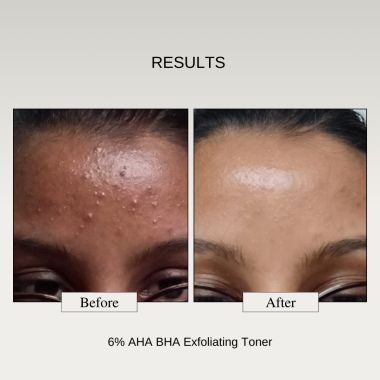The FormulaRX: 6% AHA BHA Exfoliator (5% Glycolic & 1% Salicylic Acid) Exfoliating Serum For Whiteheads, Enlarged Pores, Dark Spots