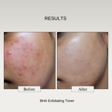 The FormulaRX: 2% BHA Exfoliator- Salicylic acid + Niacinamide - 100ml