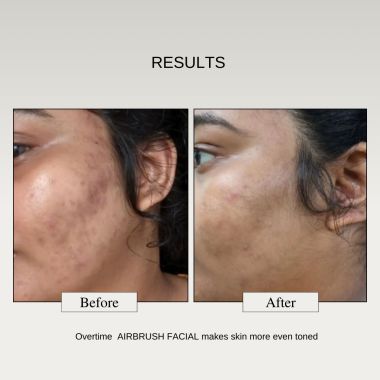 The FormulaRX: Air Brush Facial - All In One 10% Lactic Acid Exfoliating, Glowing & Brightening Serum For all skin types