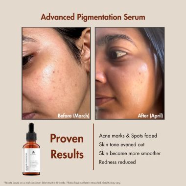 Suganda: Advanced Pigmentation Serum - 30ml