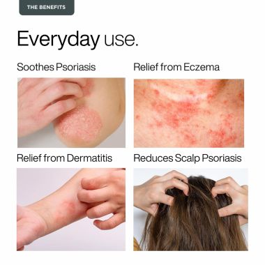 Puretive: Psoricare Body Oil | Psoriasis and Eczema Relief | Skin Allergies & Rashes