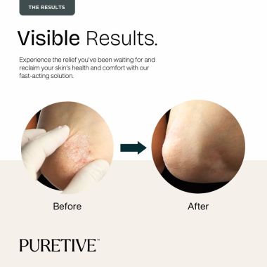 Puretive: Psoricare Body Oil | Psoriasis and Eczema Relief | Skin Allergies & Rashes