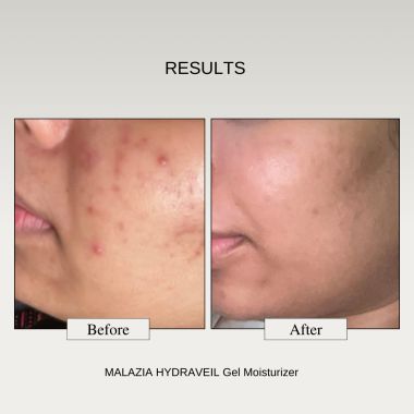 The FormulaRX: Hydra Veil Gel Moisturizer - Malazia - Oil free For Oily, Very Oily, Combination, Acne and fungal acne prone, Sensitive Skin