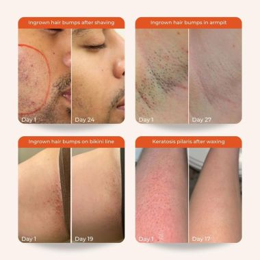 Skinvest: Bye Bye Bumps Exfoliating Mist 50ml | Treats Ingrown hair, Strawberry skin, Razor bumps post waxing/shaving, Acne, Itchiness, Uneven skin texture | All Skin Types - for Men & Women