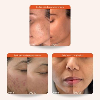 Skinvest: Clear Win Face Cleanser for pimple, acne and dark spots - 100ml | With Aloe Vera, Salicylic Acid 1% | Brightens & Hydrates Skin, Reduces Dark Spots & Blackheads | For All Skin - Men & Women