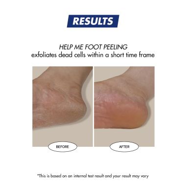 One-Day's You
: Gak Zil SSG SSG Help Me Foot Peeling