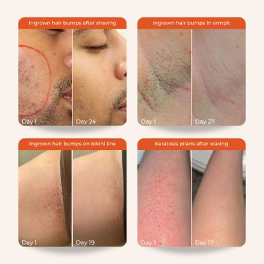 Skinvest: Bye Bye Bumps Exfoliating Mist 50ml | Treats Ingrown hair, Strawberry skin, Razor bumps post waxing/shaving, Acne, Itchiness, Uneven skin texture | All Skin Types - for Men & Women