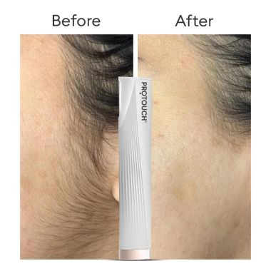Protouch: DERMA PLANNING DEVICE For Hair Removal