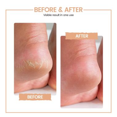 Protouch: BLISS CALLUS REMOVER