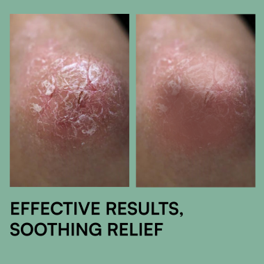 Brinton : Psoramist Moisturizing Cream  150gm