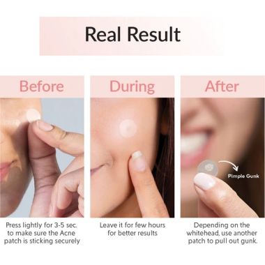 Priveda: Acne Pimple Patch - Absorbing Hydrocolloid Spot Treatment - 57 Patches
