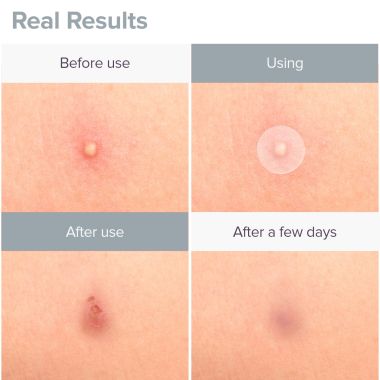 Priveda: Spot Clearing Acne Pimple Patch - 57 Patches