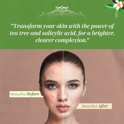 VITMINVEDA: Tea Tree & Salicylic Acid Face Serum for Acne - 30 ml