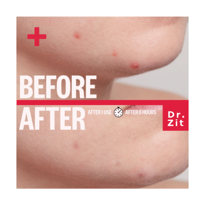 Spot Patch: Dr Zit 42 Acne Pimple Patches - 42 Pcs