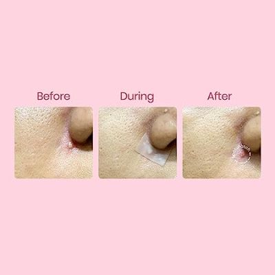 Spot Patch: Freecut 10x10cm Acne Pimple Patch Sheet