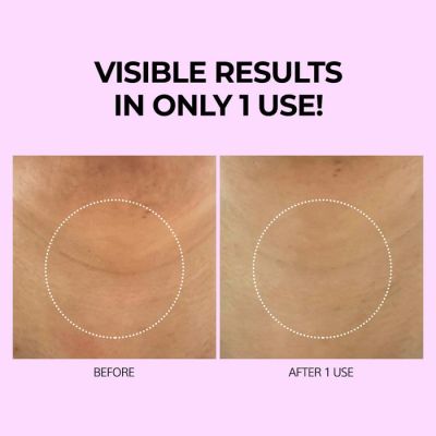 VariHope: Biotics Firming Neck Wrinkle Patch - 5 Patches