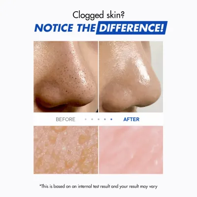 One-Day's You
: P.Z. SSOC SSOC No More Blackhead