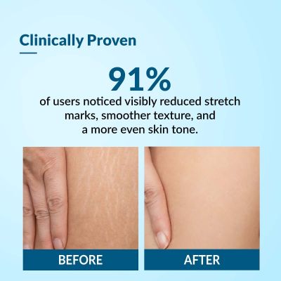 Fixderma: Strallium Anti Stretch Mark Cream  - 75gm