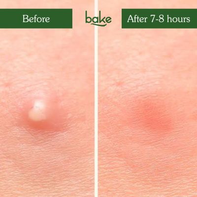 Bake Cosmetics: Zit Erase Micro point Patches   Pack of 9 Patches  30gm