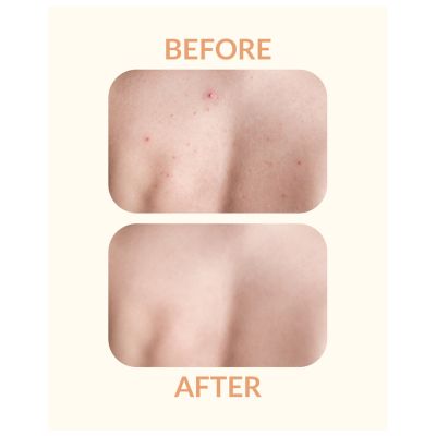 Priveda: Spot clearing Patch, Hydrocolloid Large Acne Pimple Patch Spot Treatment - 10 Patches