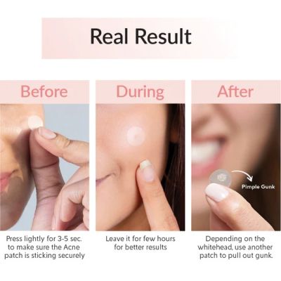 Priveda: Acne Pimple Patch - Absorbing Hydrocolloid Spot Treatment - 57 Patches