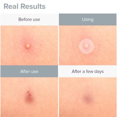 Priveda: Spot Clearing Acne Pimple Patch - 57 Patches