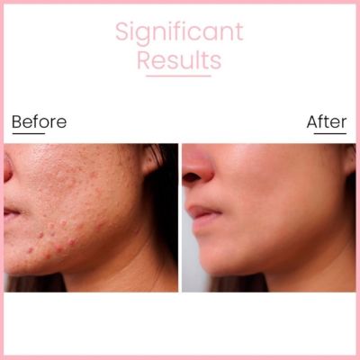 Anveya: Goodbye Acne Serum With Niacinamide, Azelaic Acid & Hyaluronic Acid - 30ml