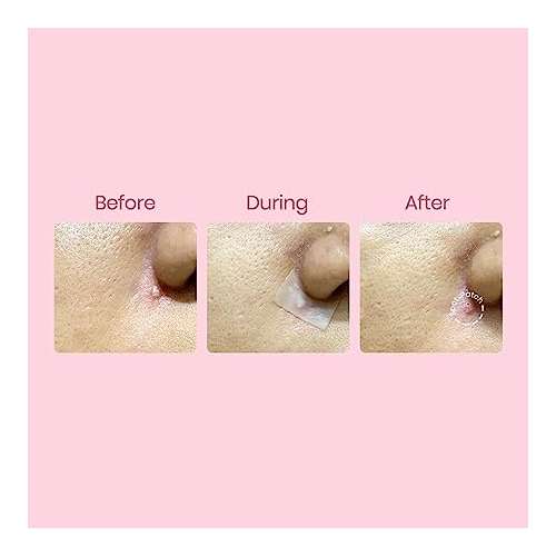 Spot Patch: Freecut 10x10cm Acne Pimple Patch Sheet