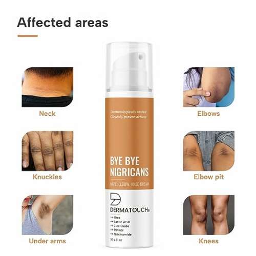 Dermatouch: Bye Bye Nigricans Cream - 30gm
