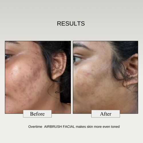 The FormulaRX: Air Brush Facial - All In One 10% Lactic Acid Exfoliating, Glowing & Brightening Serum For all skin types
