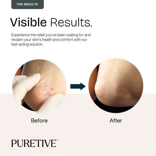 Puretive: Psoricare Body Oil | Psoriasis and Eczema Relief | Skin Allergies & Rashes Puretive: Psoricare Body Oil | Psoriasis and Eczema Relief | Skin Allergies & Rashes