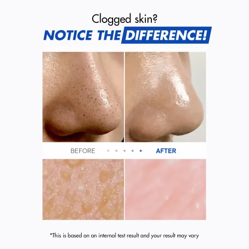 One-Day's You: P.Z. SSOC SSOC No More Blackhead