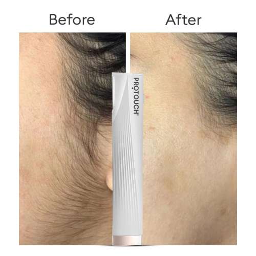 Protouch: DERMA PLANNING DEVICE For Hair Removal