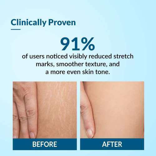Fixderma: Strallium Anti Stretch Mark Cream  - 75gm