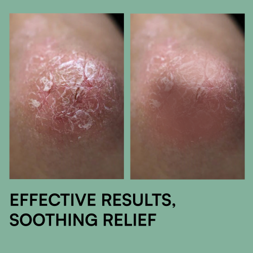 Brinton: Psoramist Moisturizing Cream  150gm