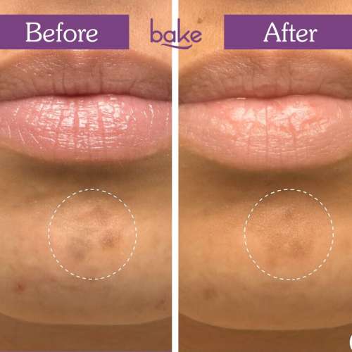 Bake Cosmetics: Spot Erase Micro point Hydrocolloid Patches for Dark Spots, Post Acne Marks & Pigmentation-Pack of 9 Patches