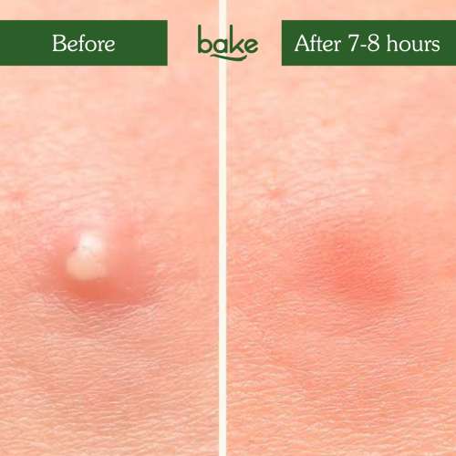 Bake Cosmetics: Zit Erase Micro point Patches for Active Acne, Unclogs Pores & Reduces Acne - Pack of 9 Patches