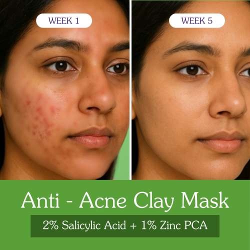 Bake Cosmetics: 2% Salicylic Acid + Zinc PCA + Niacinamide Clay Mask for Acne, Blackheads & Open Pores 100gm