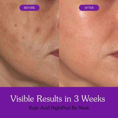 Bake Cosmetics: Night Peel RX Overnight Peel-Off Mask with Kojic Acid and Turmeric for Pigmentation, Tan, Dark Spot  100ml